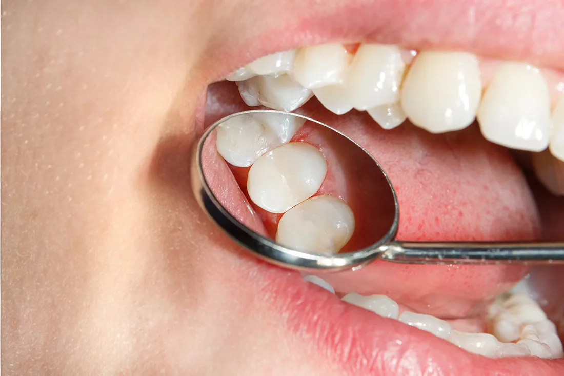 Dental mirror showing back teeth with tooth-colored fillings