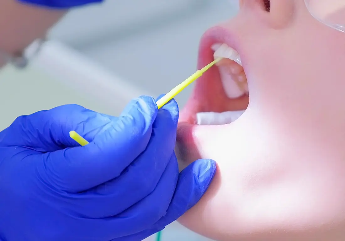 Gloved hand applying fluoride to teeth with a small applicator