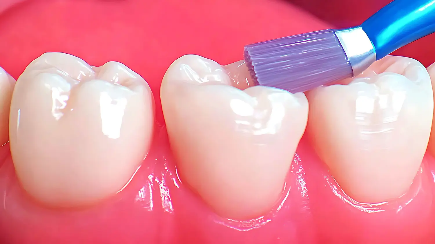 Close-up of a small brush painting sealant onto the chewing surface of a back tooth