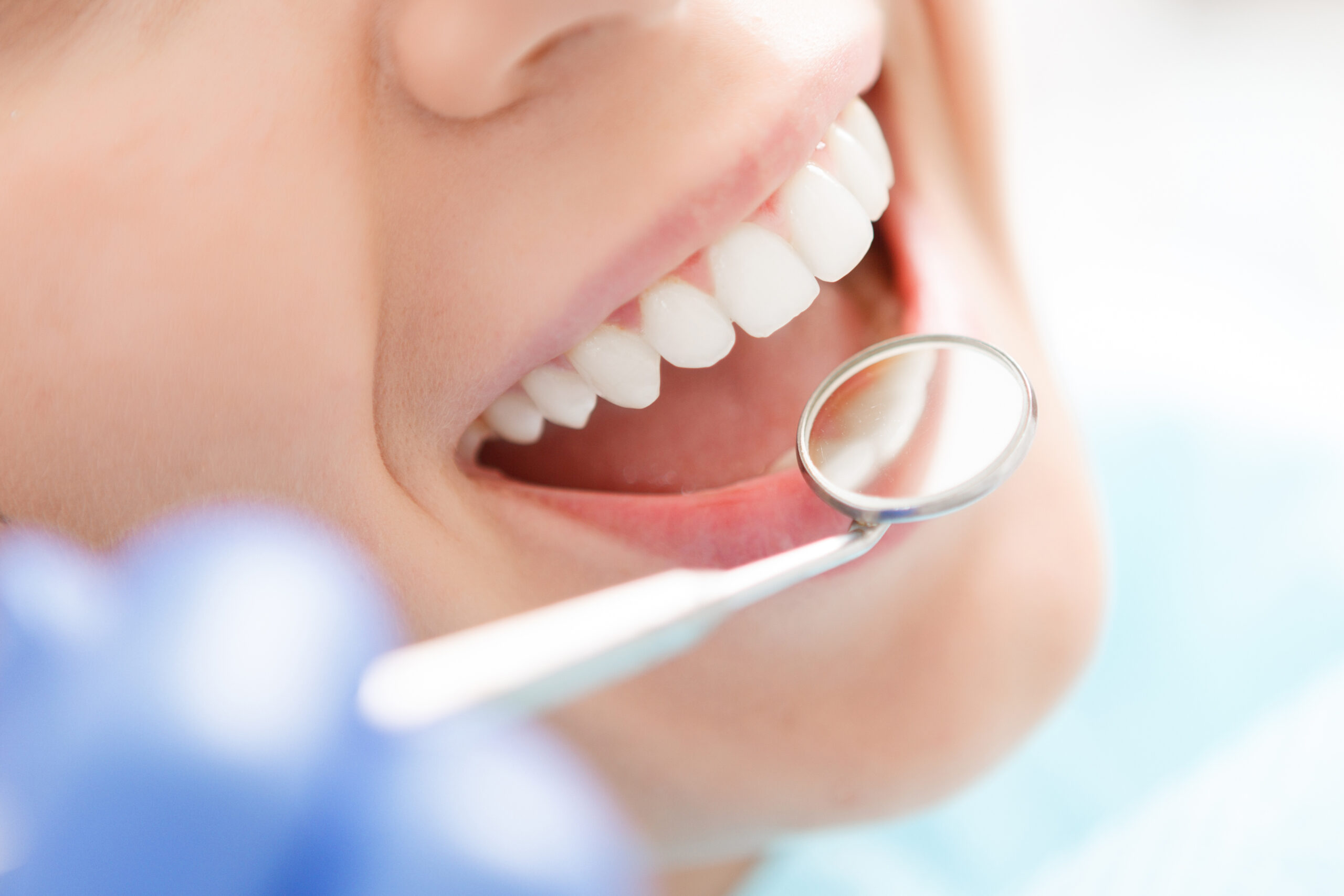 Patient smiling during a dental exam with a mouth mirror